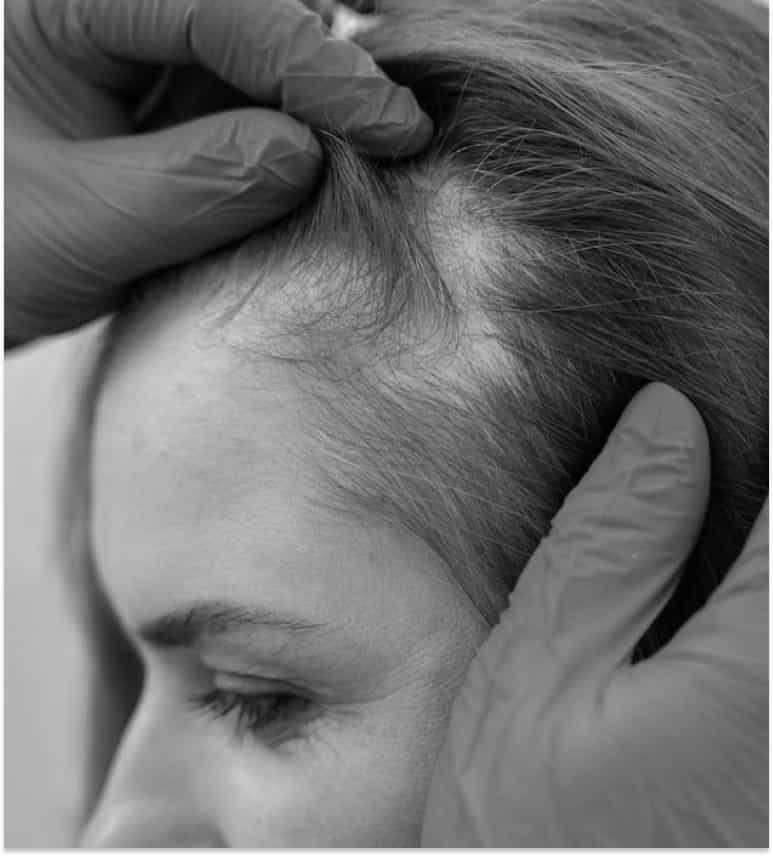 Restore your hair with advanced Female Hair Transplant treatments naturally and permanently